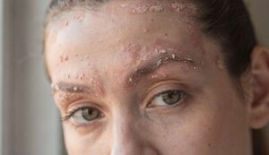 Dermatite seborroica: perché peggiora in primavera e cosa fare per tenere sotto controllo le recidive