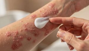 Allergia e pelle: come gestire rossori, eczemi e occhi gonfi senza peggiorare la cute sensibile