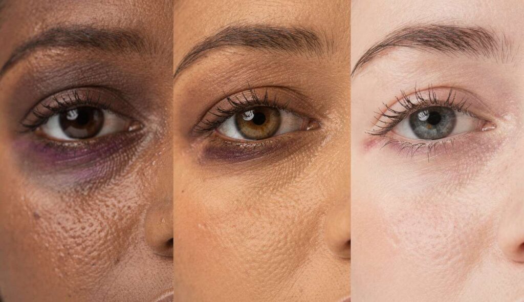 Occhiaie viola e occhiaie marroni: cause diverse, rimedi diversi. La guida del dermatologo